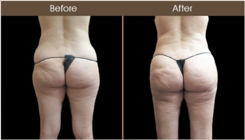 Gluteal Fat Transfer Results